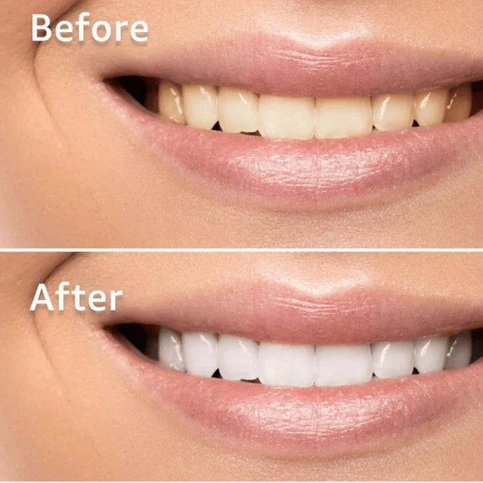 CandidBright™ Professional Teeth Whitening (14 Strips)