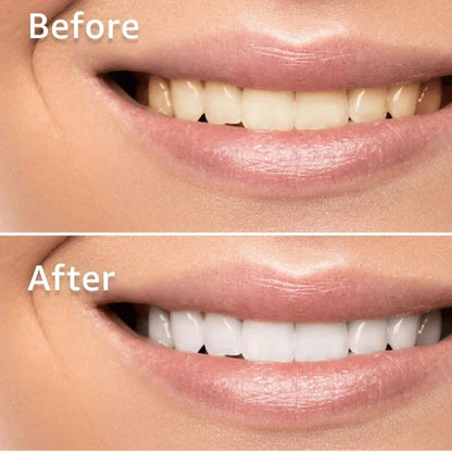 CandidBright™ Professional Teeth Whitening (14 Strips)